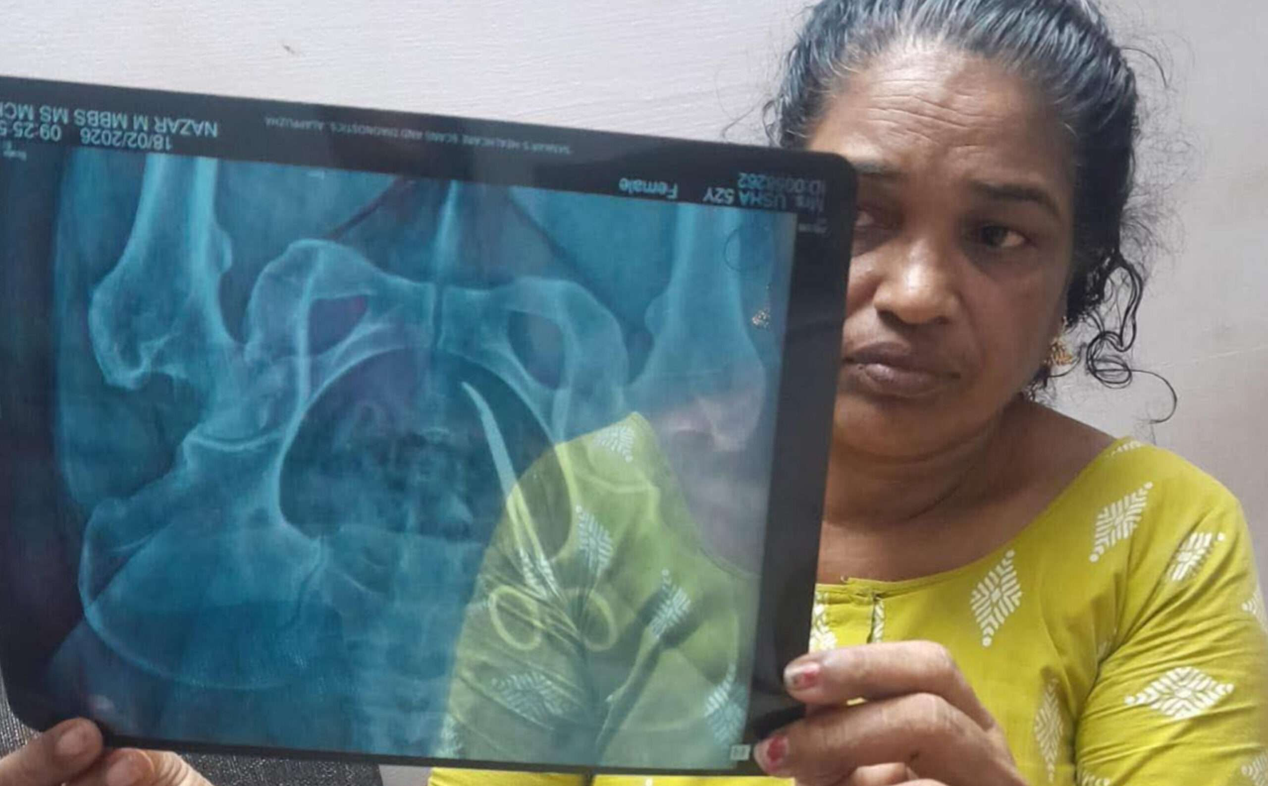 You are currently viewing ശസ്ത്രക്രിയയ്ക്ക് പിന്നാലെ വയറ്റിൽ കത്രിക; പുന്നപ്ര സ്വദേശിനിയുടെ പരാതിയിൽ അന്വേഷണം